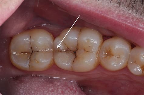 Immediate Relief: How to Stop the Pain of a Cracked Tooth