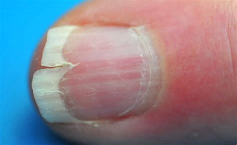 Effective Ways to Repair a Split Fingernail at Home