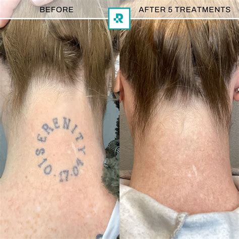Tattoo Removal Cost: What to Expect & Factors Affecting Price