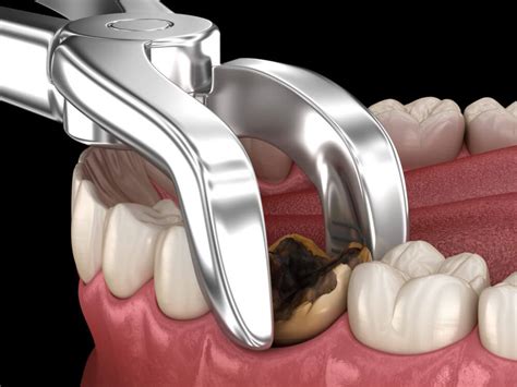 How Much Does It Cost to Remove a Tooth? Your Comprehensive Guide