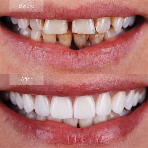Unveiling the Cost of Veneers: Your Path to a Dazzling Smile