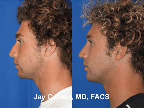 Finding the Best Rhinoplasty Surgeon in the USA: Your Journey to Facial Harmony
