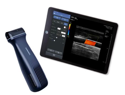 Revolutionizing Healthcare: Discover the Best Wireless Ultrasound Devices