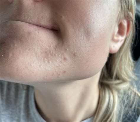 Effective Ways to Get Rid of Chin Blackheads for Clearer Skin