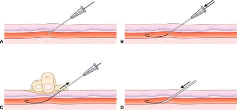 Revolutionizing Medicine: The Power of Image Guided Interventions