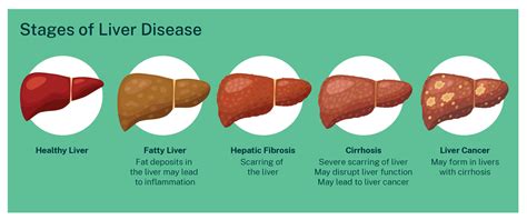 Effective Strategies to Treat Liver Disease: A Journey Towards Wellness
