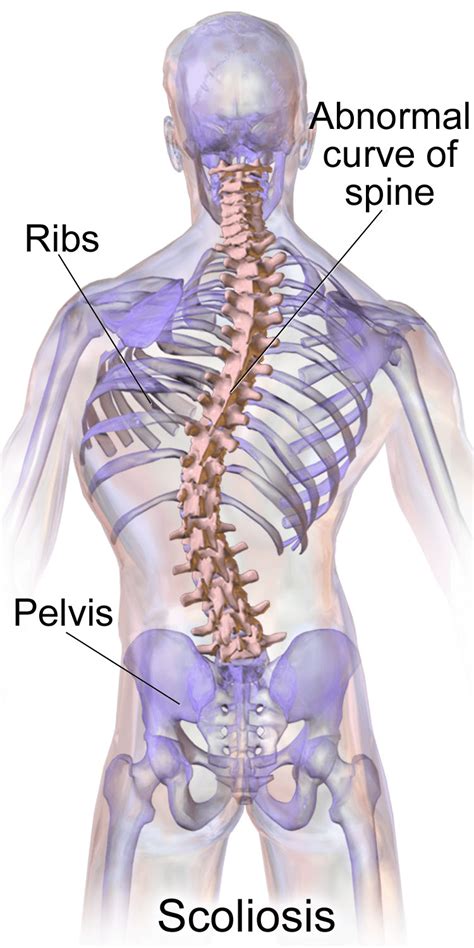Effective Treatments for Scoliosis: Finding Relief and Strength